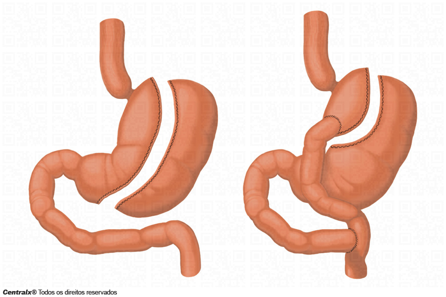 A Cirurgia Bariátrica é para Mim?